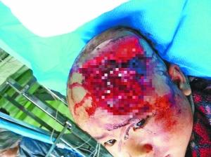 男孩受傷